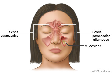 Senos paranasales en la cara alrededor de los ojos y la nariz, donde se muestran senos paranasales libres en un lado de la cara y senos paranasales inflamados con acumulación de mucosidad en un seno paranasal del otro lado.