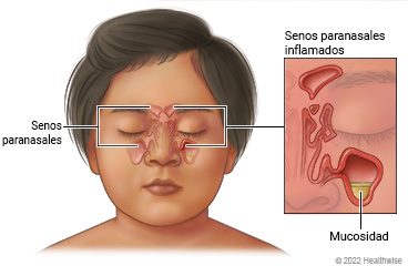 Senos paranasales en la cara de un niño alrededor de los ojos y la nariz, donde se muestran senos paranasales libres en un lado de la cara y senos paranasales inflamados con acumulación de mucosidad en un seno paranasal del otro lado.