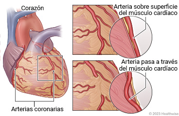 Arterias coronarias en el corazón, con detalle de la arteria sobre la superficie del músculo cardíaco y parte de la arteria que pasa a través del músculo cardíaco.