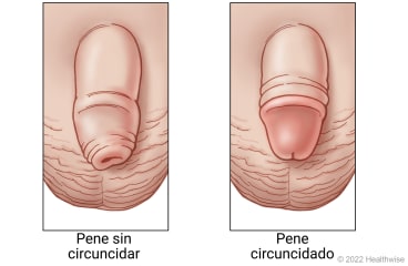 Pene no circuncidado con prepucio todavía en su lugar y un pene circuncidado sin prepucio.