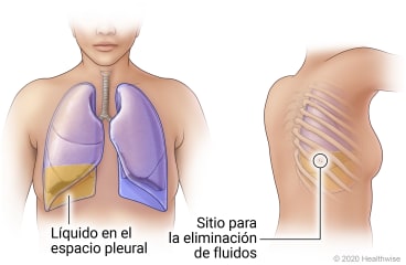 Pulmones en el tórax que muestran líquido en el espacio pleural del pulmón derecho y vista de la espalda de una persona que muestra el sitio entre dos costillas para la extracción de líquido.