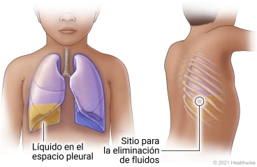 Pulmones en el tórax de un niño que muestran líquido en el espacio pleural derecho y vista de la espalda que muestra el sitio entre dos costillas para la extracción de líquido.