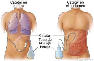 Primera imagen: catéter en tórax, con tubo conectado al frasco para recoger líquido; segunda imagen: catéter colocado en abdomen, con tubo conectado al frasco para recolectar líquido.