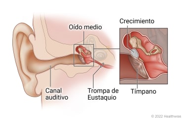 Anatomía del oído de un niño, donde se muestra el conducto auditivo, el oído medio y la trompa de Eustaquio, con detalle de una masa detrás del tímpano en el oído medio.