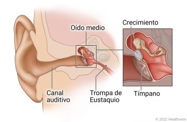 Anatomía del oído, donde se muestra el conducto auditivo, el oído medio y la trompa de Eustaquio, con detalle de una masa detrás del tímpano en el oído medio.