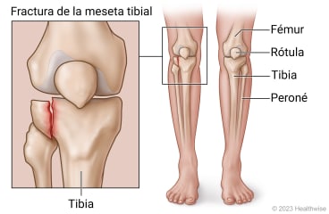 Huesos de la pierna, incluidos el fémur, la rótula, la tibia y el peroné, con detalle de la tibia rota en la fractura de la meseta tibial.