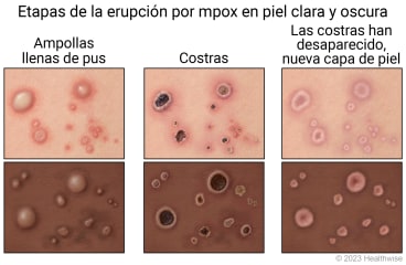 Etapas de la viruela símica en piel clara y oscura, donde se muestran ampollas llenas de pus, luego costras y, finalmente, las costras reemplazadas con una nueva capa de piel mientras sana.