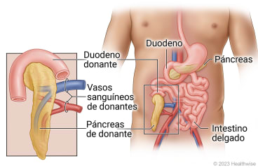 Órganos abdominales, incluidos el duodeno, el páncreas y el intestino delgado, que muestran el trasplante de duodeno, páncreas y vasos sanguíneos de un donante en la parte inferior del abdomen.