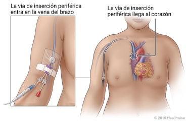 Vía PICC que entra en una vena del brazo por encima del pliegue del codo y termina cerca del corazón