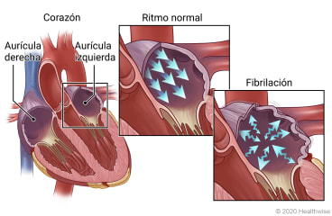 Vista interna de las aurículas derecha e izquierda del corazón, con detalles de ritmo normal y fibrilación en una aurícula.