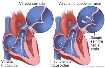 Un corazón que muestra la válvula tricúspide, con detalle de una válvula cerrada, y un corazón que muestra la válvula que no puede cerrarse y que deja que sangre se filtre hacia atrás en la aurícula.