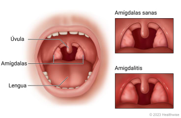 Boca de niño abierta donde se muestran la úvula, la lengua y las amígdalas, con detalle de amígdalas sanas y amígdalas enrojecidas e hinchadas debido a una amigdalitis.