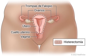 Órganos reproductores femeninos (trompas de Falopio, ovarios, útero, cuello uterino y vagina) en la pelvis, donde se destacan el útero y el cuello uterino que se extraen en la histerectomía.