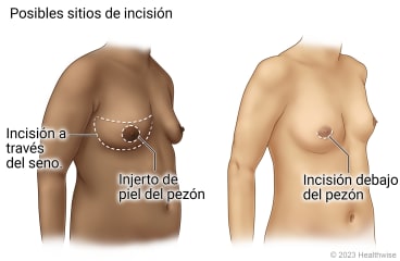 Posibles lugares de incisión, mostrando los lugares de incisión a través del seno (mama) y alrededor del pezón para el injerto de piel del pezón, y mostrando un pequeño lugar de incisión debajo del pezón.