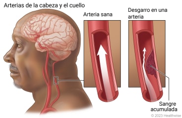 Arterias de la cabeza y el cuello, con detalle de flujo de sangre normal en un arteria sana y detalle de arteria con desgarro en la pared, lo que causa acumulación de sangre.