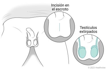 Anatomía genital masculina que muestra el pene, el escroto y los testículos, con detalle de la incisión en el escroto y detalle que muestra los testículos extraídos del escroto.