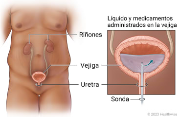 Vías urinarias en la zona pélvica, con detalle de sonda introducida a través de la uretra en la vejiga para administrar líquidos y medicamentos en la vejiga.