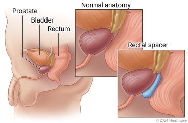 Ubicación de la próstata, vejiga y recto. Ejemplo de anatomía normal comparada con anatomía con espaciador rectal.