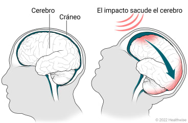 Cerebro sano en el cráneo, y un cerebro sacudido en el cráneo y dañado debido a una lesión por impacto.