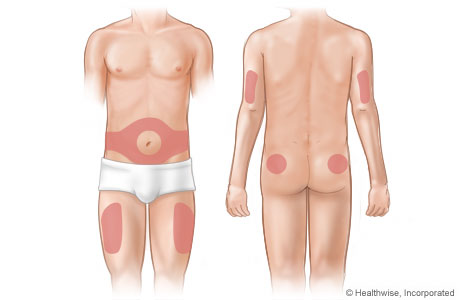 Zonas del cuerpo en las que se puede administrar insulina