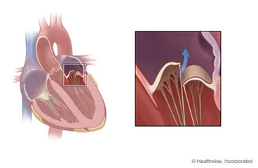 Imagen de la insuficiencia valvular mitral