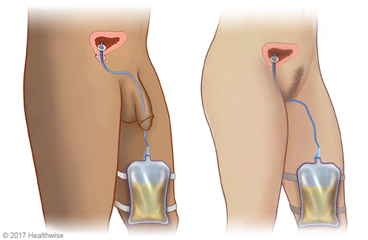 Anatomía masculina y femenina con sonda permanente colocada