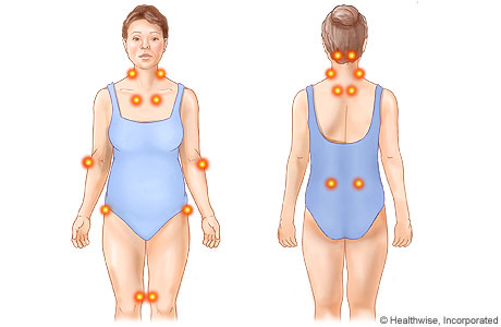 Puntos hipersensibles de la fibromialgia