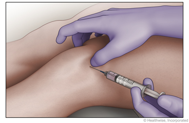 Ubicación de la aguja para una infiltración en la articulación de la rodilla