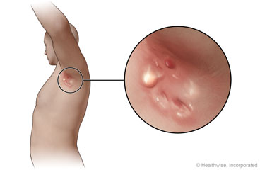 Hidradenitis supurativa en la axila, con vista en primer plano de los bultos