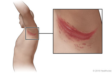 Candidiasis cutánea en la axila, con detalle de la infección