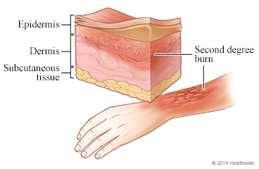 Imagen de una quemadura de segundo grado en el brazo