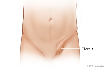 Imagen de una hernia inguinal