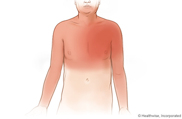 Posibles zonas en las que se siente el dolor de la angina de pecho