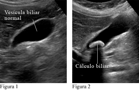 Ecografía abdominal de la vesícula biliar