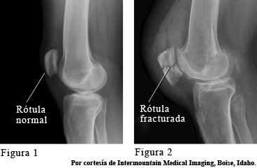 Una rótula normal y una rótula fracturada