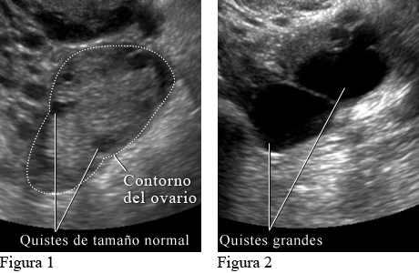 Ecografías de quistes ováricos