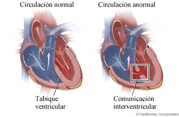 Un corazón normal y un corazón con comunicación interventricular