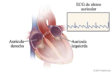 Aurículas derecha e izquierda del corazón, con ejemplo de ECG de aleteo auricular