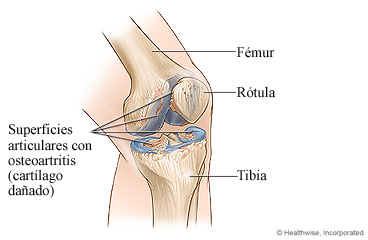 Articulación de rodilla con osteoartritis