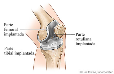 Cirugía de reemplazo de rodilla completada