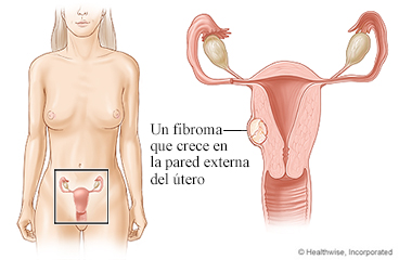 Un fibroma uterino