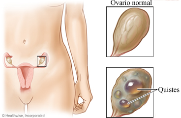 Ovario normal y quiste ovárico