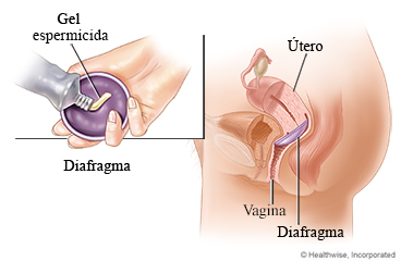 Imagen de un diafragma y su posición en la vagina