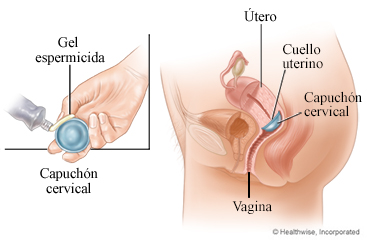 Imagen de un capuchón cervical y su posición en la vagina