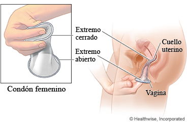 Cómo insertar un condón femenino