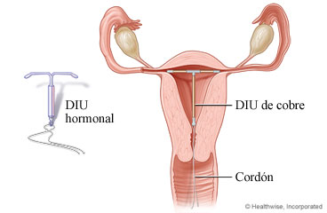 Dos tipos de dispositivo intrauterino o DIU