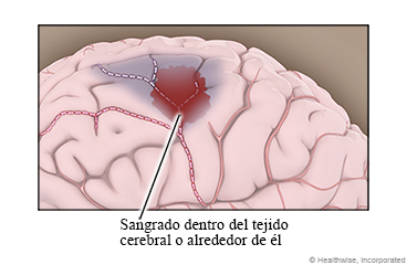 Sangrado dentro del tejido cerebral o alrededor de él