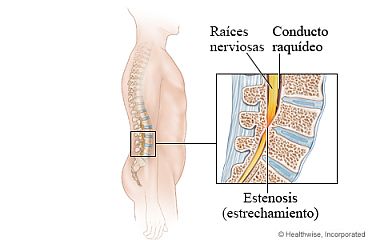 Vista ósea de la columna vertebral, con detalle del conducto raquídeo estrechado en la parte baja de la espalda