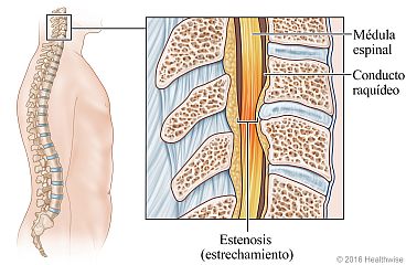 Vista ósea de la columna vertebral, con detalle del conducto raquídeo estrechado en la zona cervical (cuello)