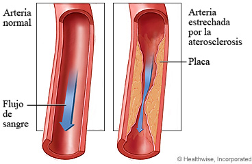 Arteria y circulación sanguínea normales y arteria estrechada por la aterosclerosis